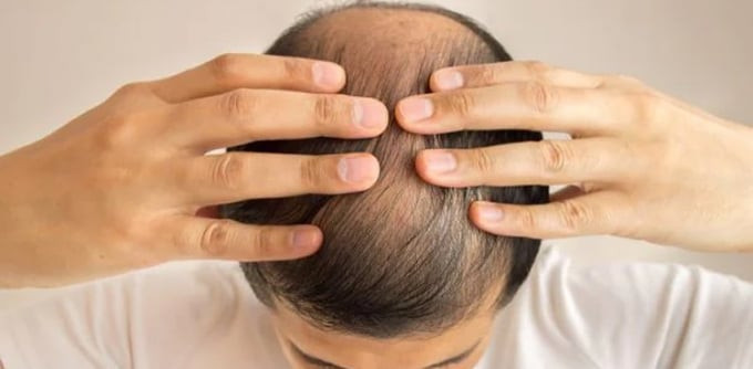 Rụng tóc - Mối quan tâm của người trẻ Hàn Quốc