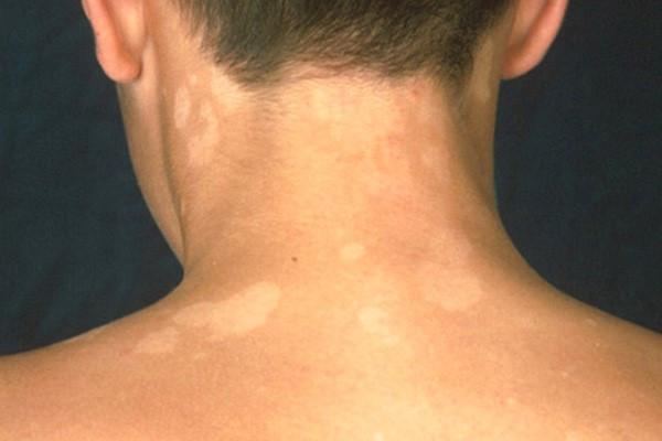 Nguyên nhân, điều trị và cách phòng ngừa bệnh lang ben