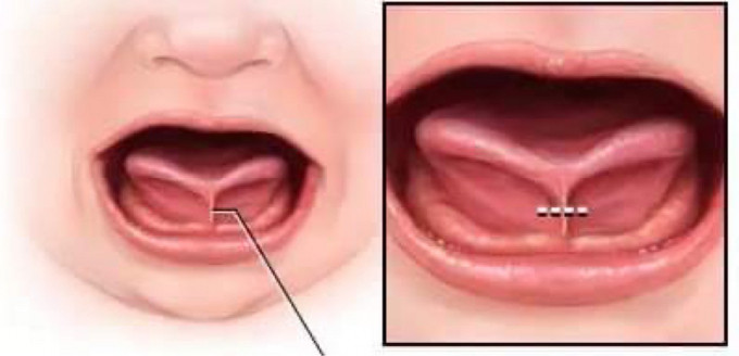 Dị tật bẩm sinh do hãm lưỡi