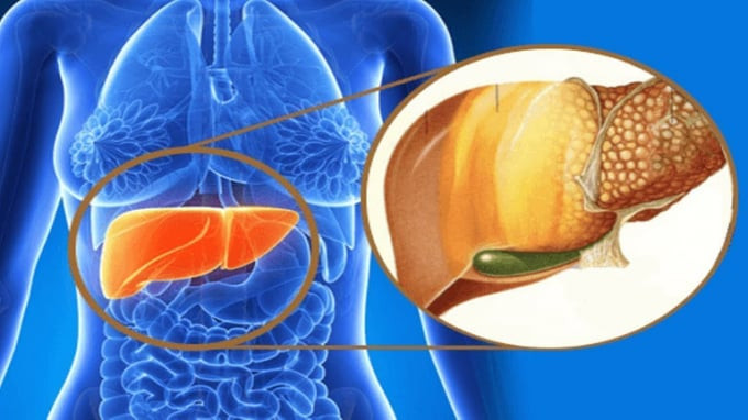 Giải quyết gan nhiễm mỡ có thể giúp bạn đề phòng hầu hết các bệnh