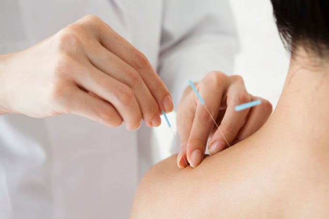 Cách châm cứu có thể giúp khôi phục sự cân bằng tuyến giáp trong cơ thể