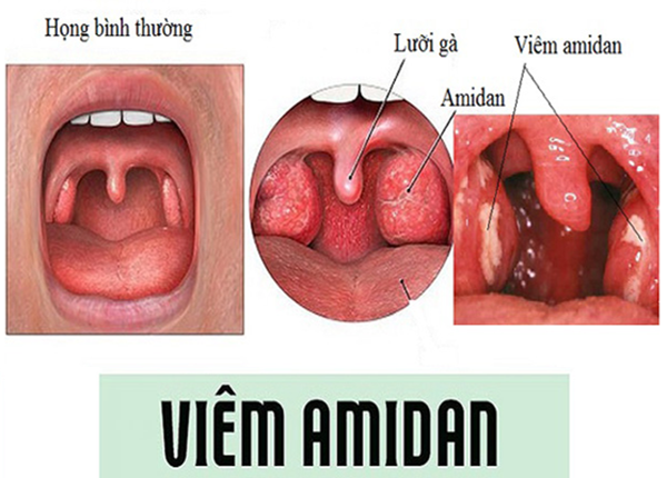 Khi nào nên thực hiện phẫu thuật cắt amidan?