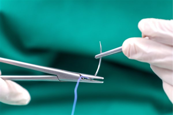 Chỉ khâu thông minh có thể cảnh báo biến chứng sau phẫu thuật
