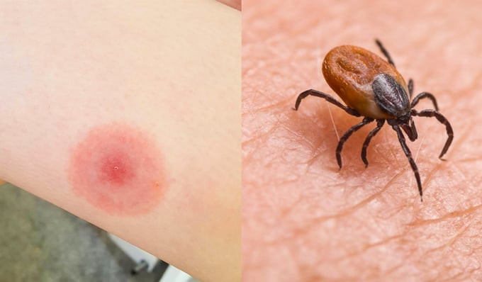 Phát hiện ra cơ chế tạo kháng thể ở người mắc bệnh Lyme