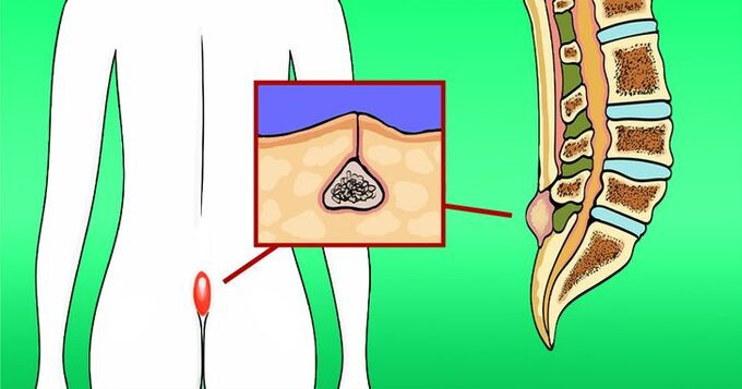 Bệnh pilonidal có xu hướng ảnh hưởng đến giới trẻ