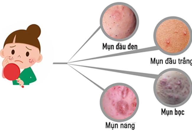 Cách chăm sóc da đúng và phù hợp để giảm bớt mụn trứng cá