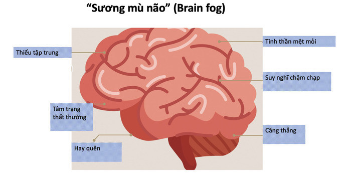 Biểu hiện của triệu chứng “sương mù não” hậu COVID-19