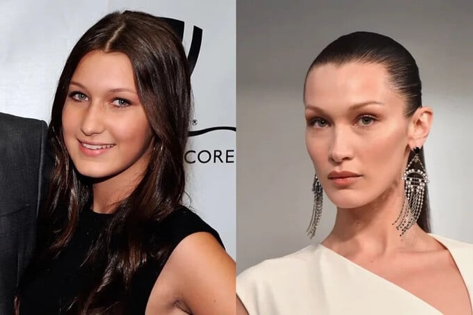 Bella Hadid chia sẻ ảnh hưởng của việc phẫu thuật thẩm mỹ quá sớm