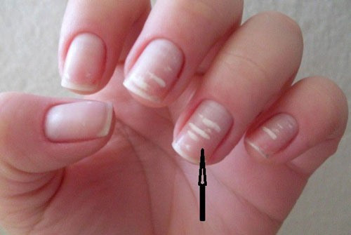 Đốm trắng trên móng tay là dấu hiệu của 5 vấn đề sức khỏe