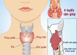 Phát hiện và điều trị bệnh u tuyến giáp sớm nhằm ngăn ngừa biến chứng và di chứng