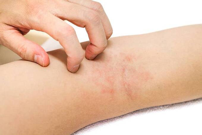 Cách chăm sóc cho bệnh viêm da cơ địa và bệnh chàm