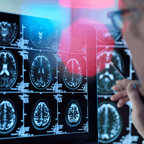 Phát hiện thêm 42 vùng gen là yếu tố nguy cơ của bệnh Alzheimer