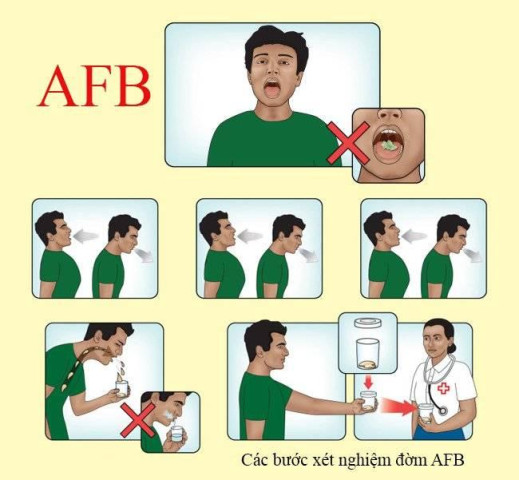 Những xét nghiệm cần làm để chẩn đoán bệnh Lao