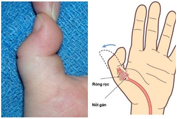 Cảnh giác với bệnh ngón tay cò súng khi thấy trẻ cầm nắm khó