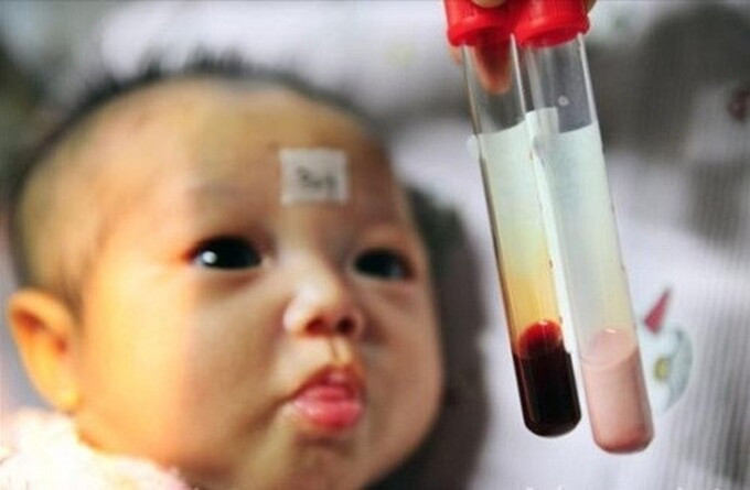 Sàng lọc Thalassemia - bệnh tan máu bẩm sinh