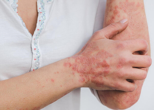 Những nguyên nhân phổ biến dẫn đến bệnh vẩy nến