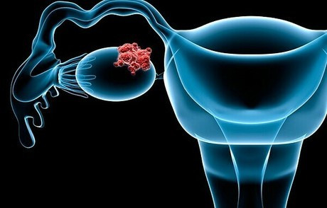 Các dấu hiệu ung thư buồng trứng tuyệt đối không được bỏ qua