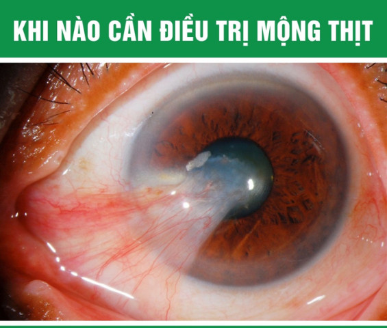 Khi nào cần điều trị mộng thịt?