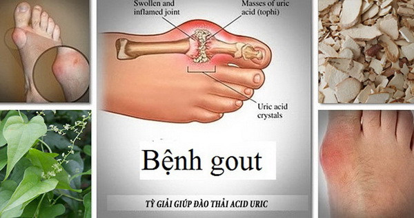 Thuốc và món ăn hỗ trợ trị bệnh gout