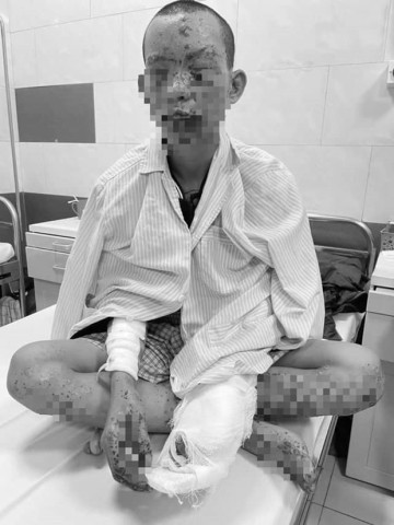 Hà Nội: Người đàn ông bị cháy xạm toàn thân khi dùng điện thoại khi đang sạc