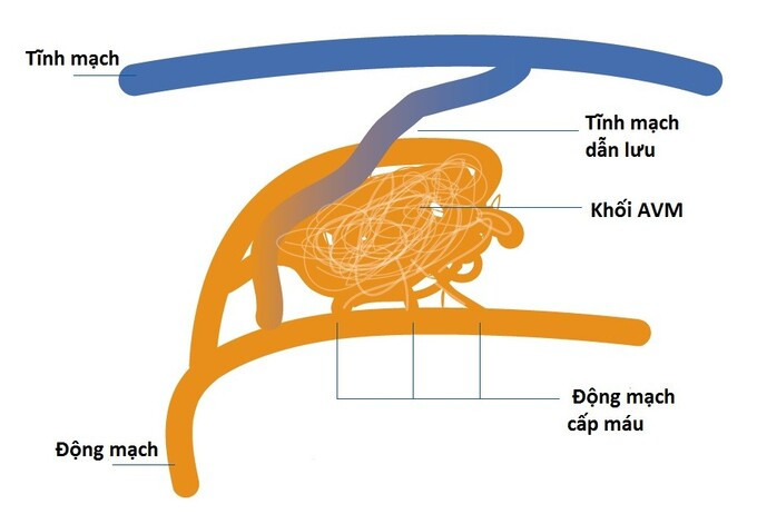 Cảnh báo dị dạng thông động tĩnh mạch não