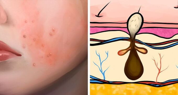 6 loại mụn và nguyên nhân gây ra chúng