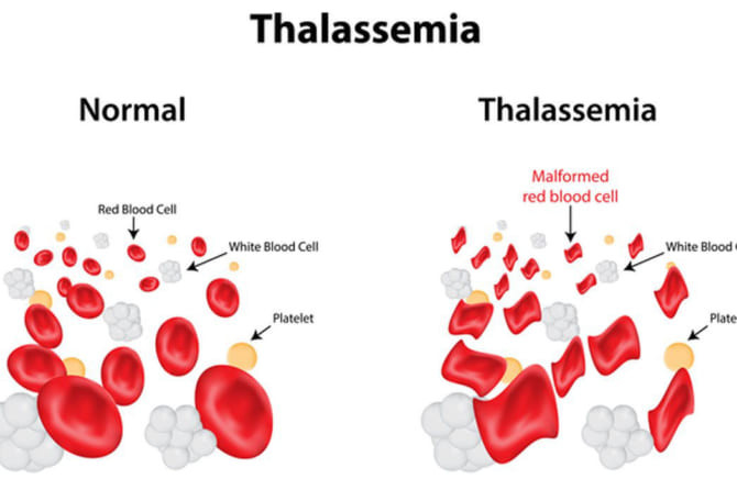 Ngày Thalassemia Thế giới 8/5/2022: Cách phòng căn bệnh di truyền có tỷ lệ cao nhất trên thế giới
