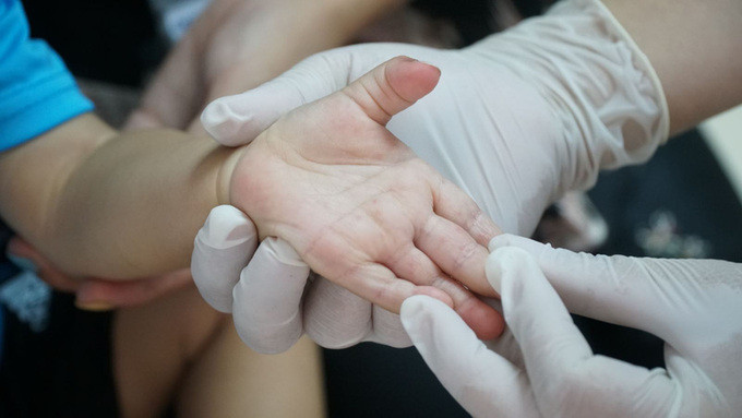 Đắk Lắk: Bệnh Tay chân miệng bắt đầu gia tăng