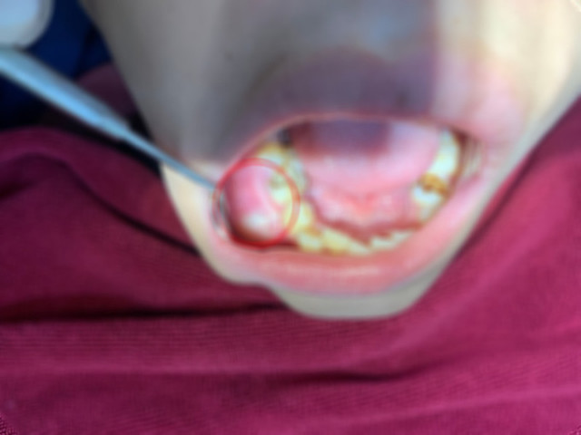Phú Thọ: Bé 12 tuổi phải nhập viện vì biến chứng nang xương hàm