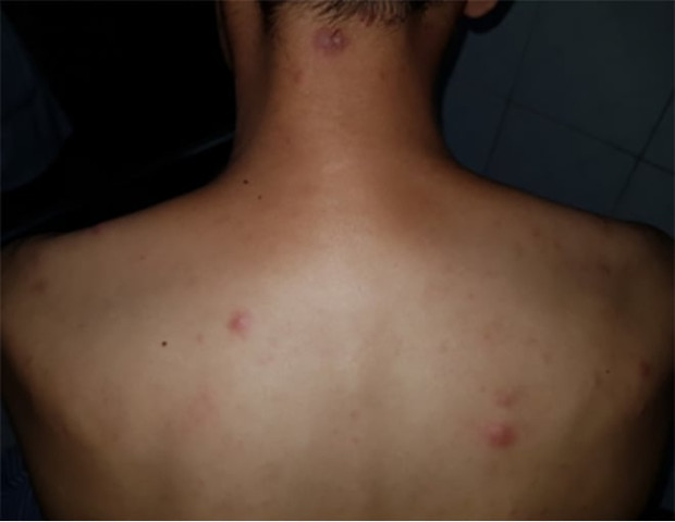 Việt Nam chính thức xoá sổ bệnh phong