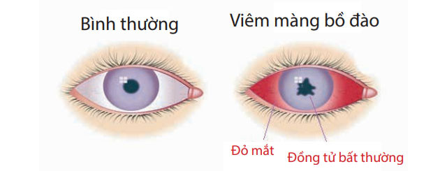Bệnh viêm màng bồ đào là gì?