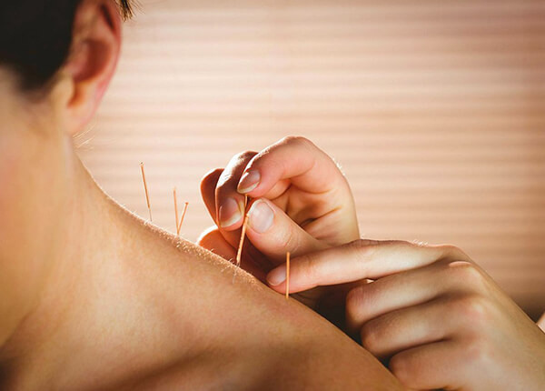 Châm cứu chữa mất ngủ và giúp ngủ ngon hơn