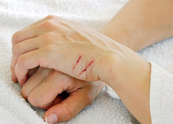 Triệu chứng ban đầu của bệnh viêm mô tế bào