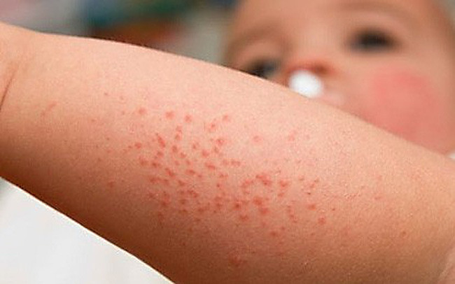 Dịch sốt xuất huyết tại Hà Nội bắt đầu có xu hướng gia tăng
