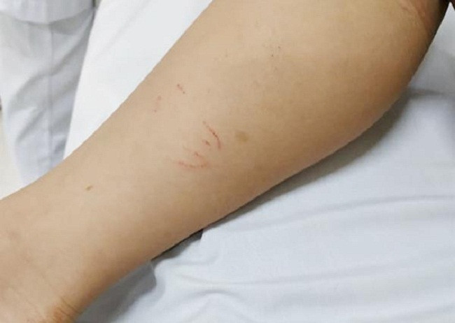 Cách sơ cứu và điều trị khi bị rắn cắn