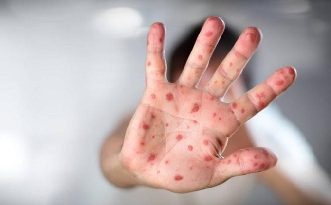 Cách chăm sóc trẻ bị tay chân miệng