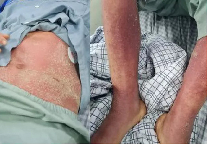 Phú Thọ tiếp nhận 2 bệnh nhân bị viêm màng não, nhiễm khuẩn huyết do liên cầu lợn