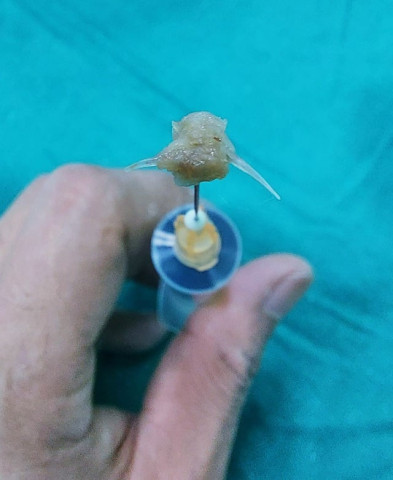 Nghệ An nội soi gắp dị vật là mảnh xương cá ra khỏi đường thở của bệnh nhi 2 tuổi