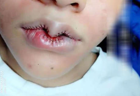 Đồng Nai xử phạt 90 triệu đồng cơ sở làm đẹp phẫu thuật "lệch môi" cho khách hàng