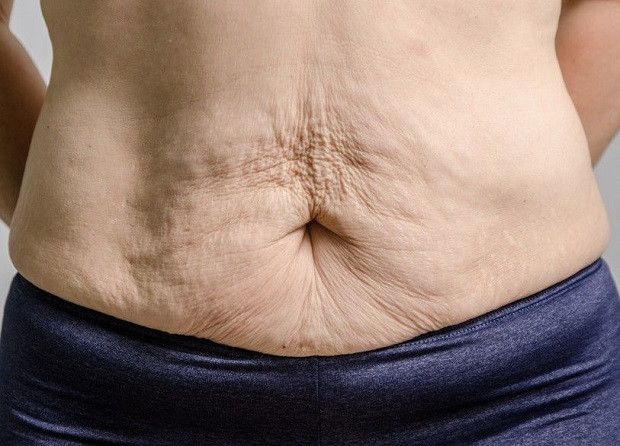 Mách bạn cách để không bị da nhão, chảy xệ trong quá trình giảm cân