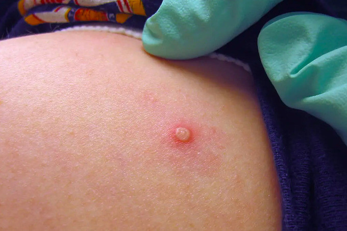 WHO: Virus đậu mùa khỉ có thể đã âm thầm lây lan một thời gian dài trước đó