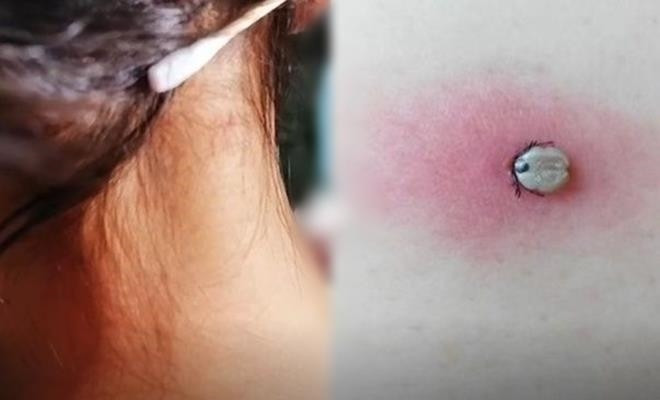 Trung Quốc: Người mẹ rùng mình khi biết "nốt ruồi lạ" trên người con là "quái vật" hút máu