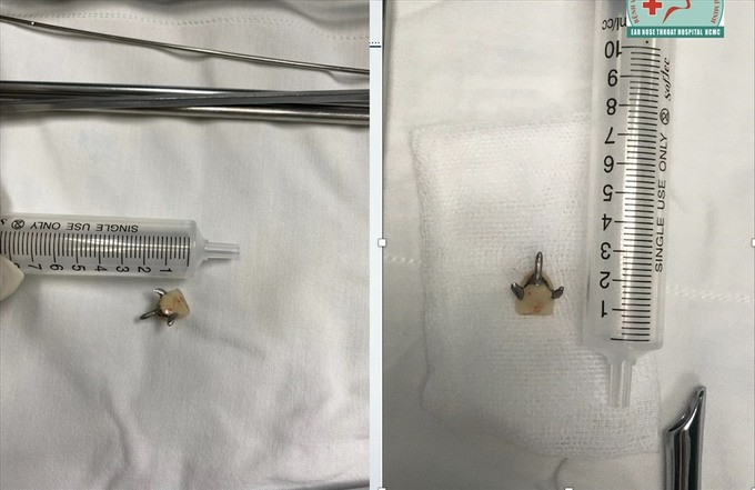 TP. HCM phẫu thuật thành công cho bệnh nhân bị rơi răng giả vào phổi