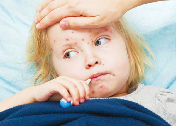 Điều trị và phòng ngừa bệnh sởi