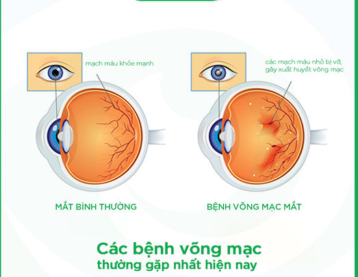 6 bệnh võng mạc thường gặp nhất hiện nay