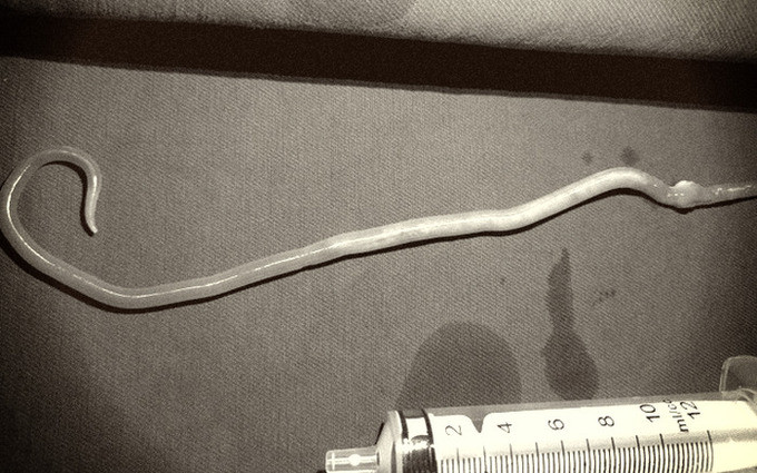 Quảng Ninh: Gắp giun đũa gần 20 cm trong ống mật chủ của bé gái 11 tuổi