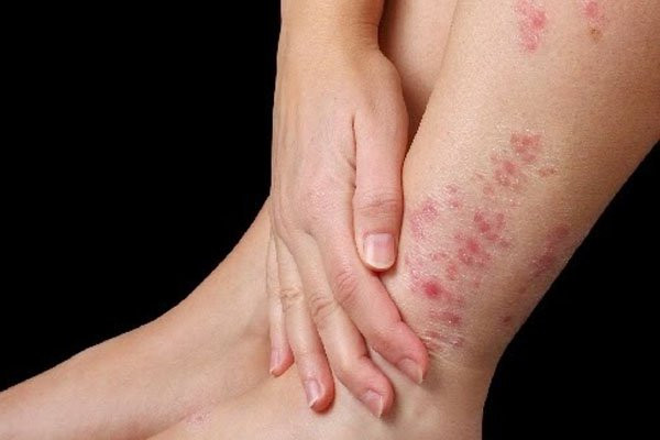 Những mẹo giảm những cơn ngứa ngoài da không cần gãi