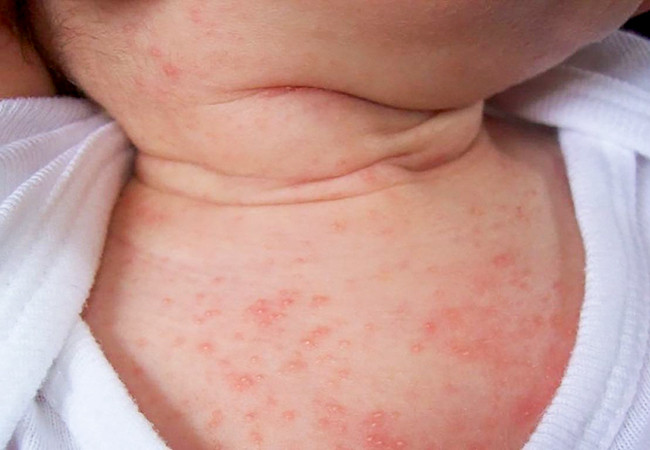 Tình trạng rôm sảy ở trẻ em gia tăng vào mùa hè