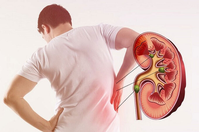 Hành vi gây hại cho thận ở nam giới