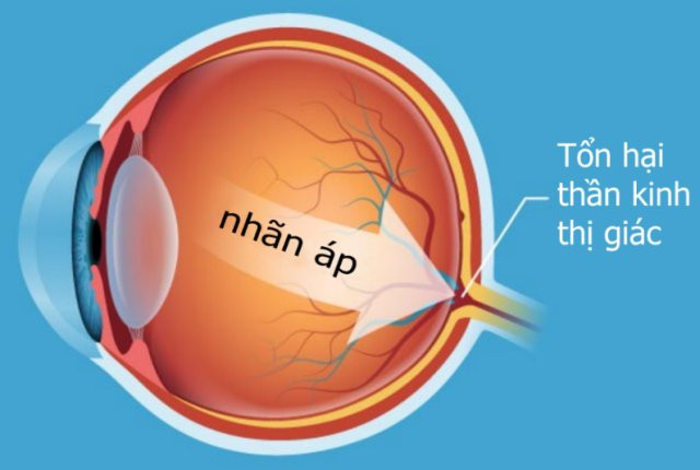 Cách nhận biết sớm bệnh tăng nhãn áp glôcôm